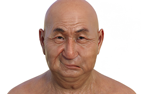 중추성 안면마비 이미지